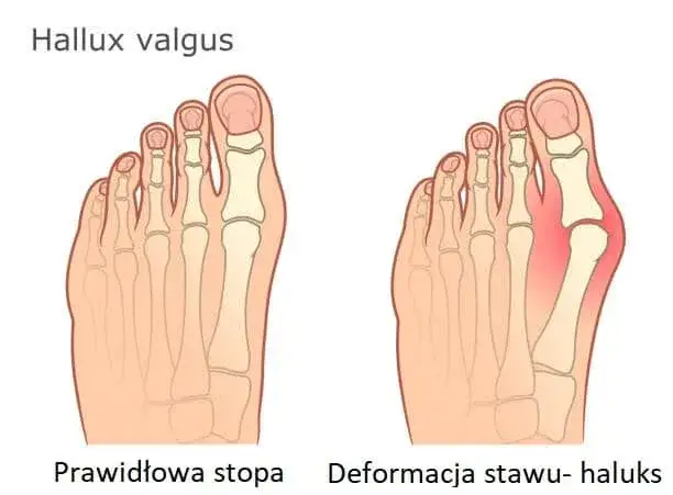 Jak wygląda haluks? Rozpoznaj objawy i stadia palucha koślawego
