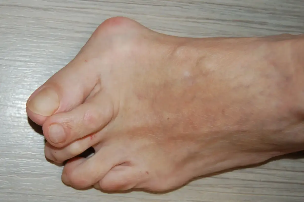 Stopa z widocznym haluksem na lewej stronie, na jasnym tle.