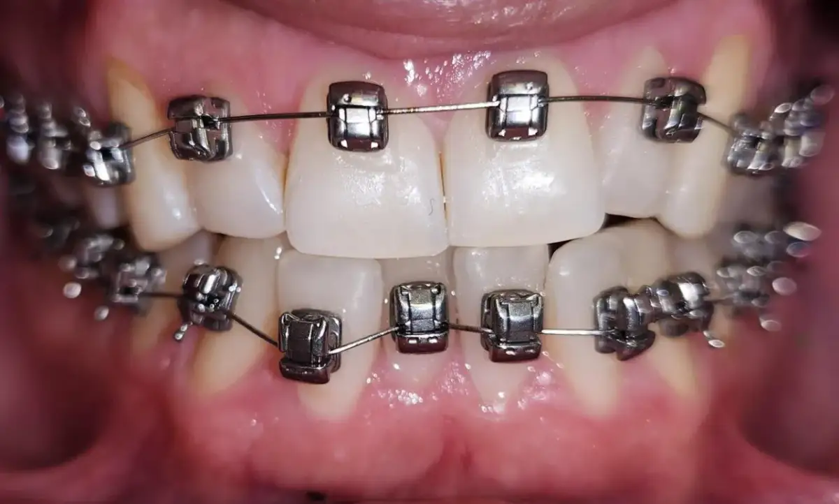 Aparat stały na zęby: zobacz, jak wygląda i wybierz swój typ