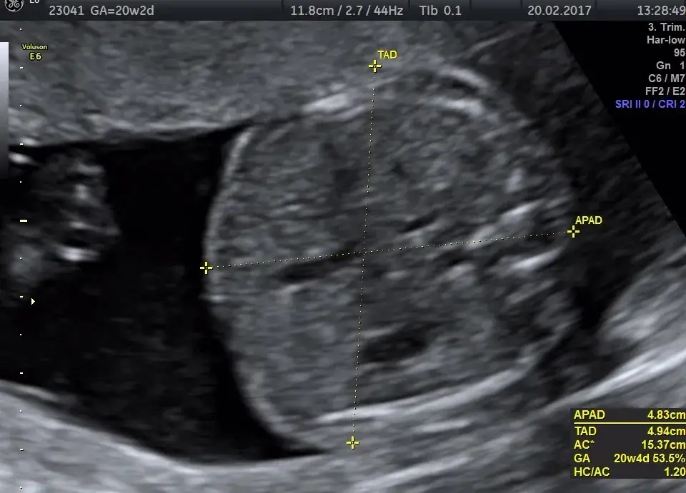 Jak wyglądają badania połówkowe? Co musisz wiedzieć przed USG