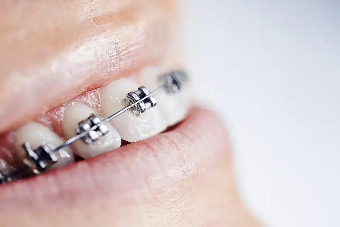 Aparat na zęby: Czy zawsze na wszystkie? Kiedy wystarczy jeden łuk?