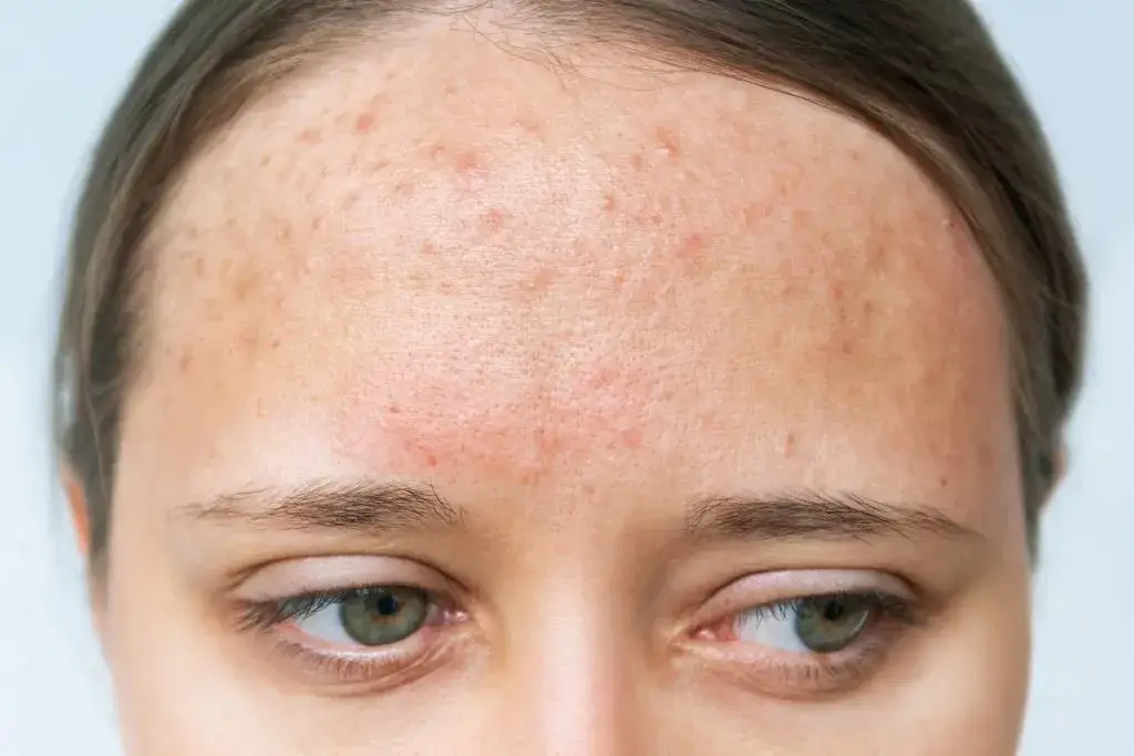 Alergia na mleko u dorosłych: objawy skórne, diagnoza i leczenie