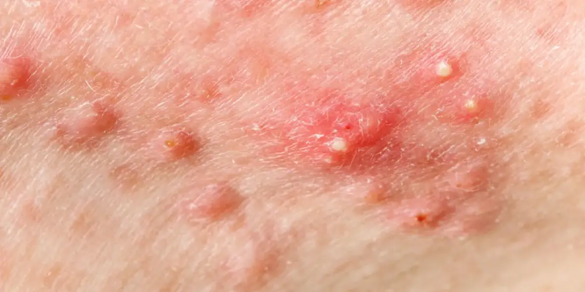 Ropny pryszcz? Poznaj sekrety gładkiej skóry bez blizn!