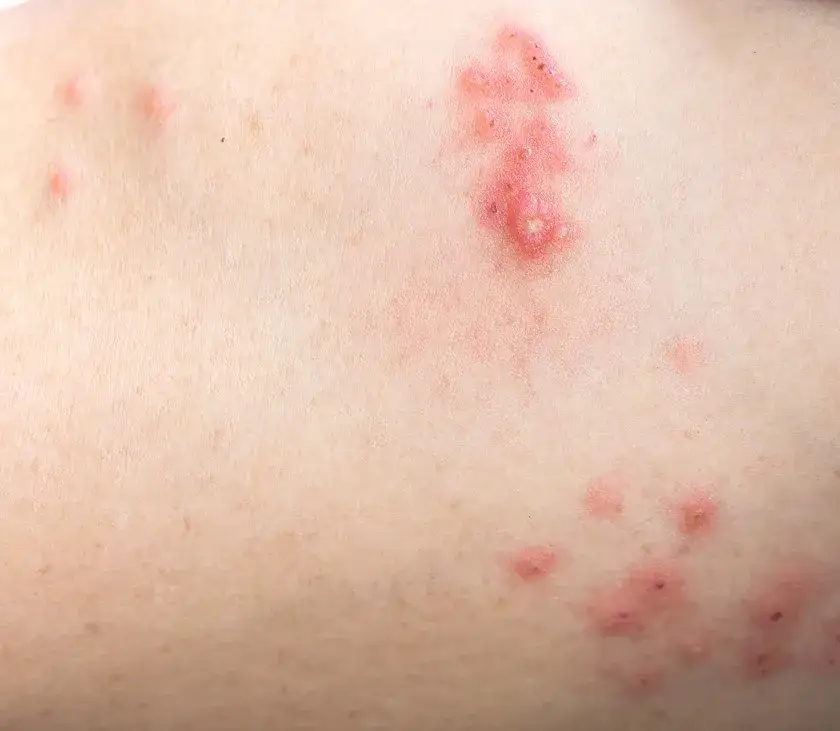 Jak wygląda półpasiec u dziecka? Objawy, które mogą cię zaskoczyć