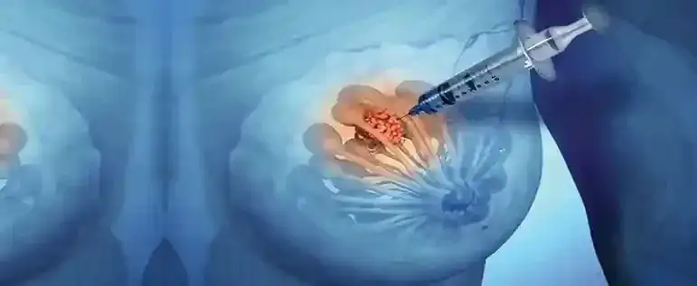 Biopsja piersi - ile trzeba czekać na wyniki i co wpływa na czas?