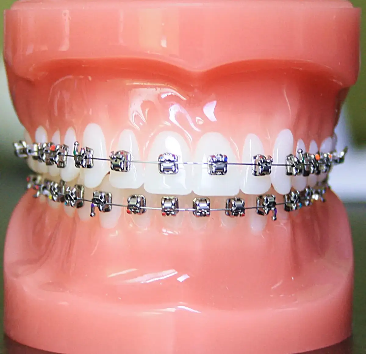 Ile naprawdę kosztuje stały aparat na zęby i jak uniknąć ukrytych opłat