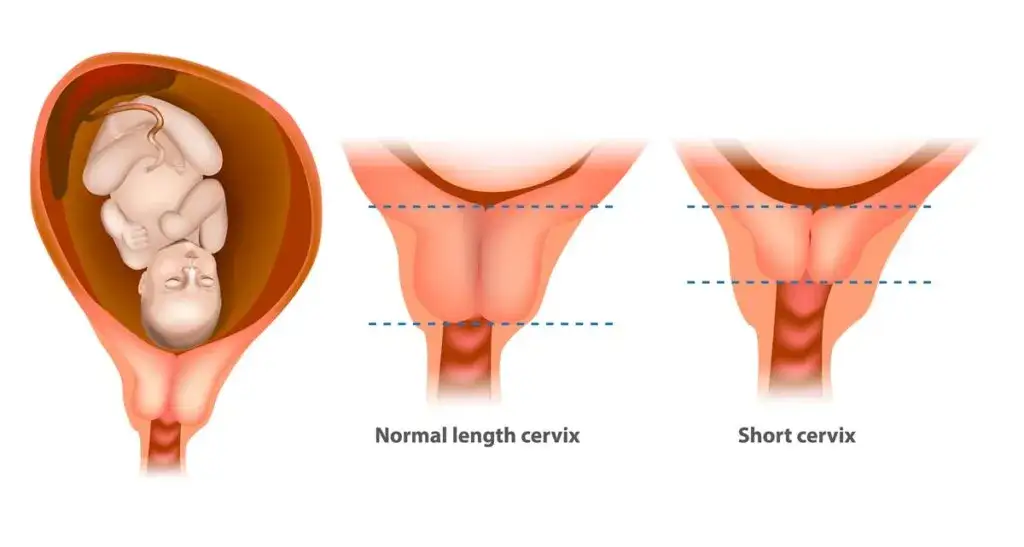 Ile przed porodem skraca się szyjka macicy? Kluczowe informacje dla przyszłych mam