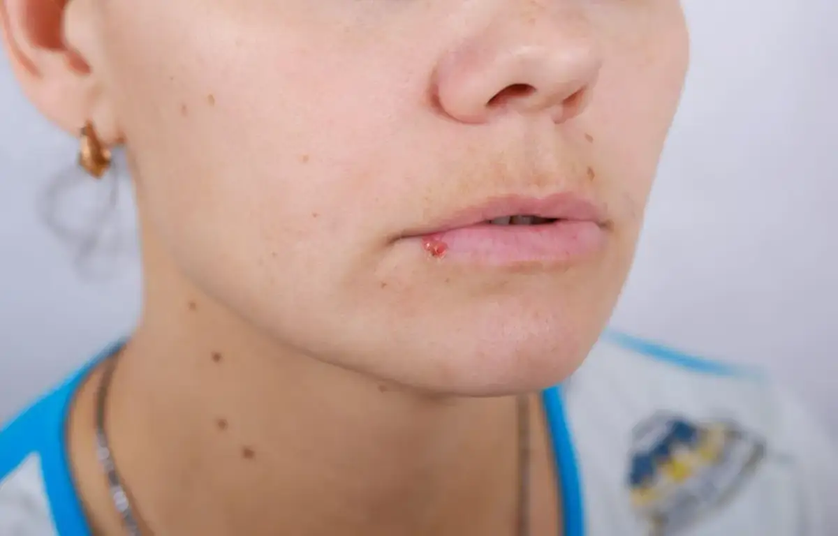 Czy z opryszczką można iść do dentysty? Ryzyka i zalecenia przed wizytą