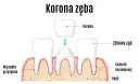 Ilustracja pokazuje proces zakładania korony zęba. Widoczne są zdrowe zęby, cement korzeniowy, kość i więzadło przyzębne.