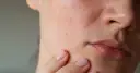 Zbliżenie na policzek z widocznymi zaczerwienieniami i pryszczami. Skóra jest lekko podrażniona, co może być przyczyną pryszczy na policzkach.