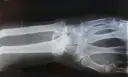 RTG nadgarstka z widocznymi zmianami sugerującymi wrodzoną łamliwość kości.