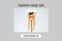 Model zęba ukazujący próchnicę sięgającą miazgi, co prowadzi do zapalenia miazgi.