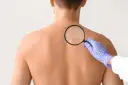 Dermatolog bada plecy pacjenta z licznymi białymi plamami na skórze, używając lupy.