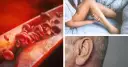 Miażdżyca objawy psychiczne: Jak choroba wpływa na Twoje zdrowie psychiczne?