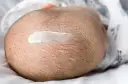 Główka niemowlęcia z objawami łojotokowego zapalenia skóry. Na skórze widoczne są żółtawe łuski i biały krem.