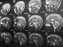 Czy rezonans magnetyczny wykrywa schizofrenię? Seria przekrojów mózgu na obrazach MRI pokazuje jego strukturę, ale nie diagnozuje schizofrenii.
