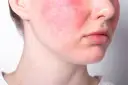 Cera naczynkowa, zaczerwienione policzki i widoczne naczynka. Jak się pozbyć tego problemu i odzyskać zdrowy wygląd skóry?