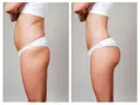 Liposukcja: Kompleksowy przewodnik po zabiegu i kosztach w Polsce