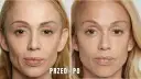 Modelowanie żuchwy przed i po. Porównanie twarzy kobiety przed i po zabiegu, ukazujące subtelne zmiany w linii żuchwy.