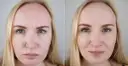 Mezoterapia igłowa przed i po: wygładzona skóra, zredukowane zmarszczki na czole i wokół oczu. Efekt odmłodzenia.
