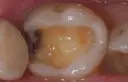 Czy dziura w zębie zarasta sama? Prawda o naturalnym gojeniu