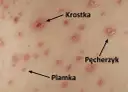 Zmiany skórne: plamki, krostki i pęcherzyki, charakterystyczne dla ospy.