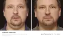 Przed i po zabiegu lipolizy podbródka. Widoczna redukcja tkanki tłuszczowej i poprawa napięcia skóry.