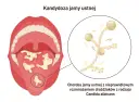 Ilustracja przedstawia jamę ustną z białymi nalotami na języku i podniebieniu, wskazującymi na grzybicę jamy ustnej. Obok powiększony obraz drożdżaków Candida albicans.