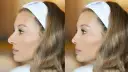 Profil kobiety z opaską na włosach, porównanie przed i po. Widoczna subtelna zmiana nosa, 2 tygodnie po operacji nosa.