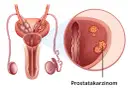 Was wird bei der Prostatakrebs Vorsorge gemacht? Wichtige Schritte erklärt