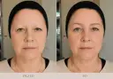 Efekt metamorfozy: rekonstrukcja brwi metodą włoskową nadała twarzy wyrazistości i młodzieńczego blasku.
