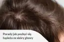 Skóra głowy z widocznym łupieżem. Szukasz skutecznego płynu na łupież, który pomoże Ci pozbyć się tego problemu?