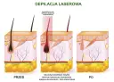 Ilustracja pokazuje laserowe usuwanie wąsika: przed zabiegiem, ekspozycję na laser i efekt po.