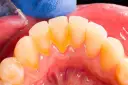 Widoczne żółte przebarwienia i osad, czyli kamień nazębny, przy linii dziąseł. Dentyści usuwają go specjalnymi narzędziami.