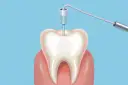 Ilustracja zęba z narzędziem dentystycznym w środku.