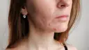 Skóra z widocznymi zmianami trądzikowymi, w tym pryszcze na czole i policzkach. Szuka rozwiązania, co na pryszcze na czole.