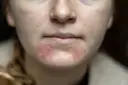 Gesichtshaut spannt extrem? Ursachen & Soforthilfe vom Experten