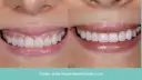 Uśmiech przed i po: zredukowany gummy smile, odsłonięte piękne, białe zęby.