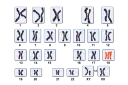 Kariotyp przedstawia pary chromosomów, w tym jedną parę w kolorze pomarańczowym, sugerującą anomalię.