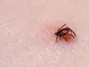 Garrapata de perro, con su cabeza dentro de la piel, lista para alimentarse.