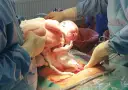 Noworodek wychodzi z brzucha mamy, ręce lekarzy pomagają w porodzie, który był w położeniu miednicowym.
