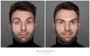 Przed i po zabiegu botoksem na czoło. Widoczna redukcja zmarszczek mimicznych.