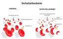 Sichelzellanämie Diagnose: Labor, Tests & Gentest erklärt