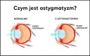 Astygmatyzm: Skąd się bierze? Geny, urazy, choroby wszystko o nim
