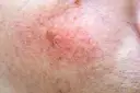 Skóra z widocznymi naczynkami i przebarwieniami, czekająca na retinol efekty.