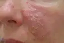 Rötungen im Gesicht: Was hilft wirklich gegen Couperose & Rosazea?