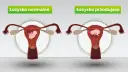 Porównanie: łożysko normalne vs. łożysko przodujące. Ilustracja pokazuje macicę z płodem, gdzie w jednym przypadku łożysko jest prawidłowo umiejscowione, a w drugim przoduje.