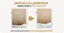 Depilacja laserowa bikini przed i po: widoczna redukcja owłosienia po 9 zabiegach. Gładka skóra bez podrażnień.