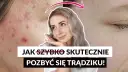 Jak pozbyć się pryszcza szybko i skutecznie - sprawdzone metody