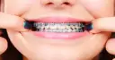 Aparat ortodontyczny: Całkowity koszt leczenia od A do Z w Polsce